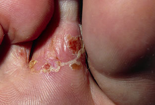 Fungi între degetele de la picioare