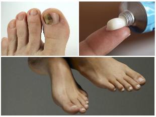 ciuperca unghiilor de la picioare unguente