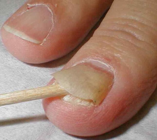 descuamarea unghiei cu ciuperca unghiilor de la picioare