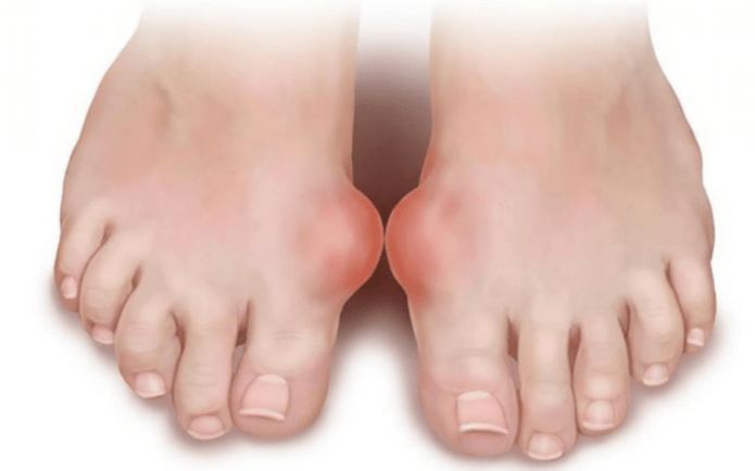 deformarea piciorului ca cauză a apariției ciupercii pe picioare