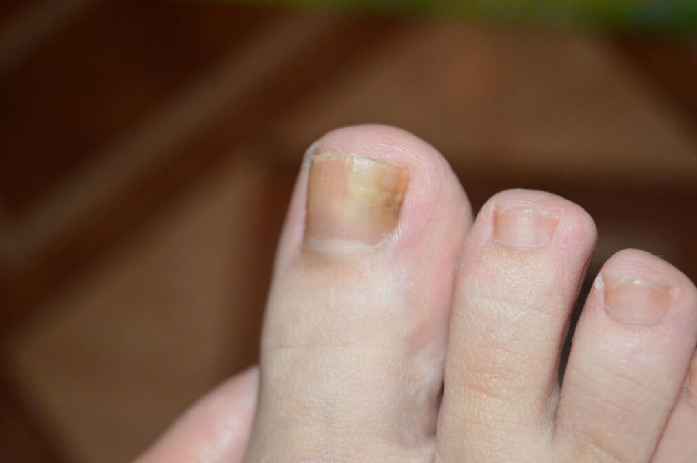 Etapa inițială a ciupercii unghiilor de la picioare