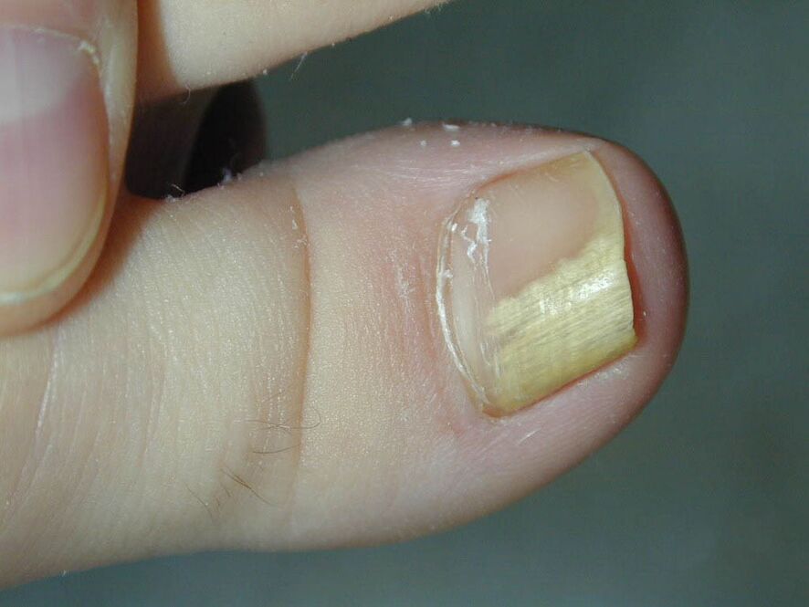 Simptom fungic - decolorarea unghiei