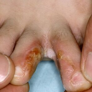 Semne de ciupercă între degetele de la picioare