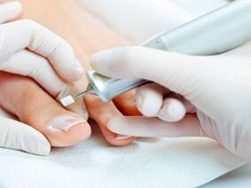 Pedichiură terapeutică pentru ciuperca unghiilor de la picioare
