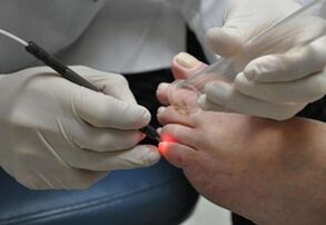 Tratament cu laser pentru ciuperca unghiilor de la picioare