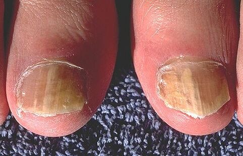 Unghii afectate de dermatofite