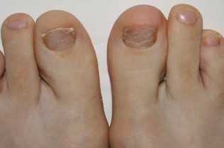 Simptome apariția ciupercilor de la picioare